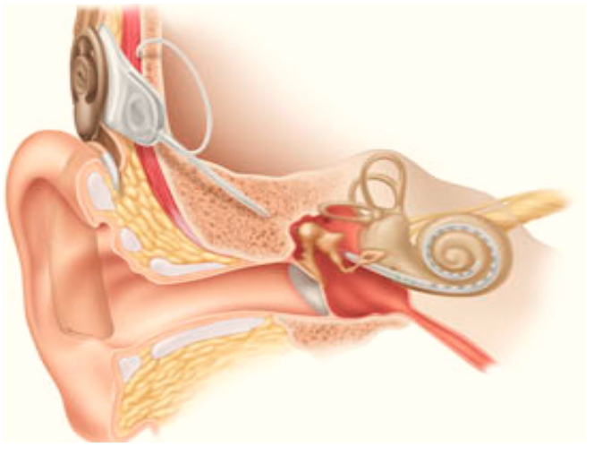 Biyonik Kulak (Koklear implant) Nedir? – Kimlere Uygulanır?