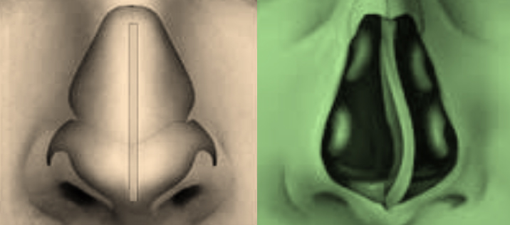 Burun Kemik Eğriliği (Septum Deviasyonu) Teşhis ve Tedavisi