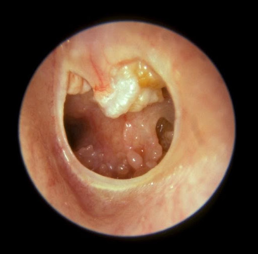 Kolesteatoma Nedir?